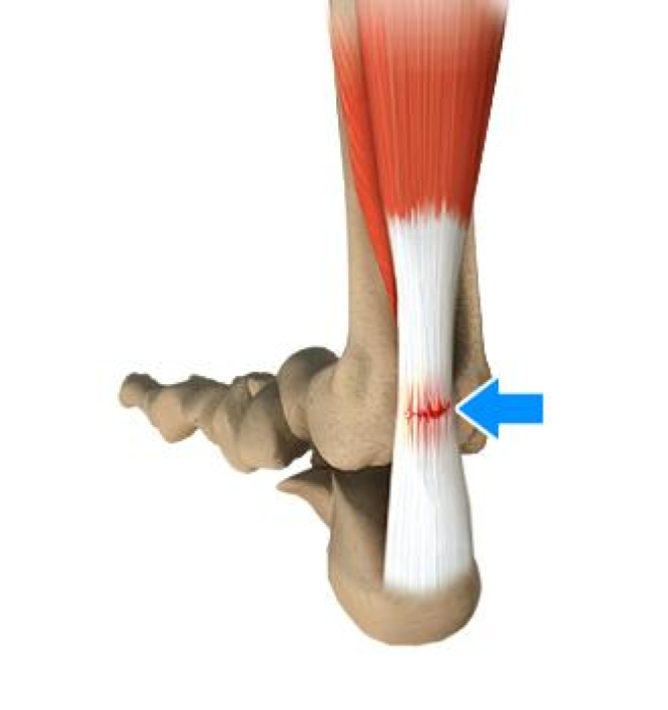 Achilles Tendon Rupture Bunbury Foot Ankle Surgeon Hot Sex Picture